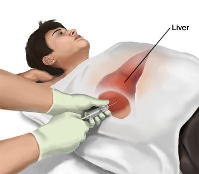 как сделать биопсию печени