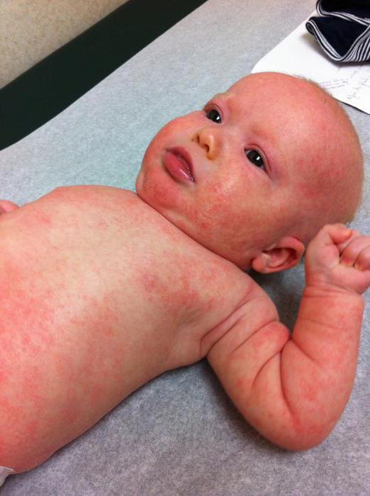 Аллергия на глютен симптомы у грудных детей