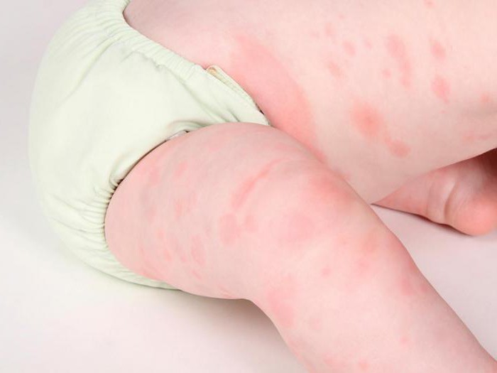 Аллергия на глютен у ребенка симптомы фото
