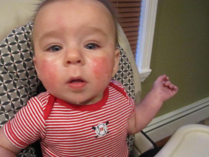 У ребенка на щеке красное шершавое пятно