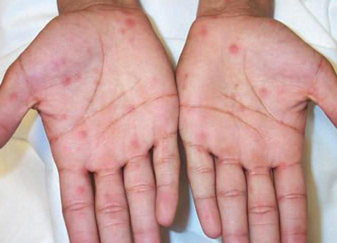 Сыпь на ладонях и ступнях у ребенка и взрослого причины аллергии