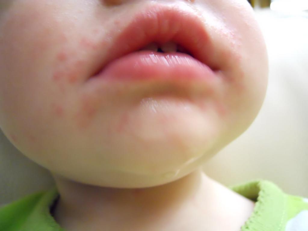 Сыпь на лице у ребенка