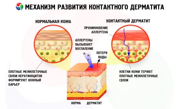 Контактный дерматит