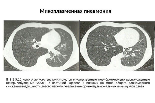 Перибронхиальные узелки