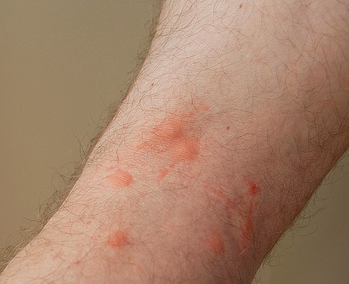 После укуса клопа на коже может проявиться аллергия