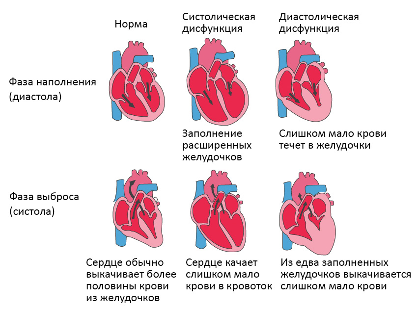 Типы сердечной недостаточности, диастола и систола