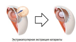 Хирургическое лечение катаракты