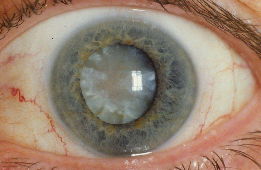 Мутный зрачок при катаракте