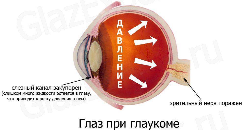 Глаз при глаукоме
