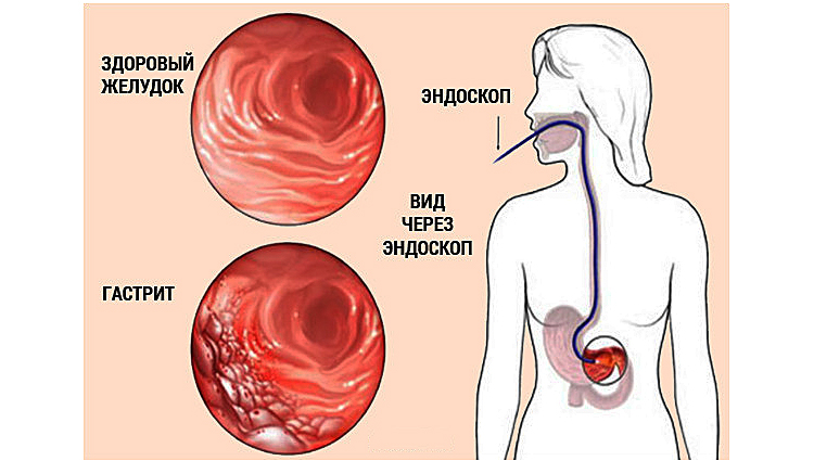 Гастрит