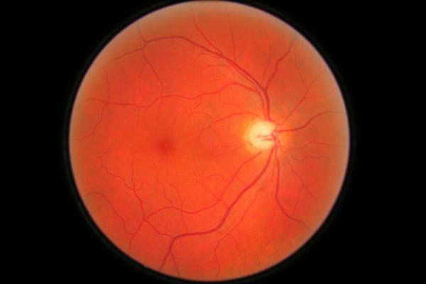 патология зрительного нерва