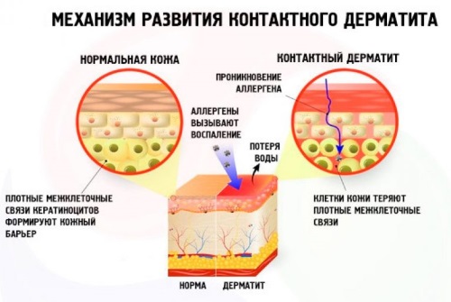 Сыпь на теле у взрослого. Что это может быть, если чешется, мелкая в виде прыщиков, крупная с покраснениями. Фото и как лечить