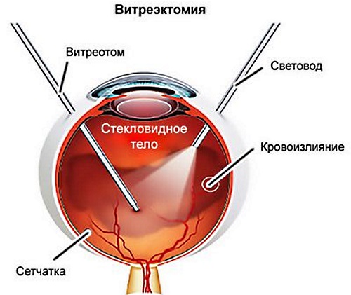 Черные точки перед глазами. Что это за пятна, причины и лечение расфокусировки зрения