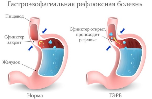 Кислый привкус во рту после еды, с изжогой и без, желтым и белым налетом на языке. Причины и лечение