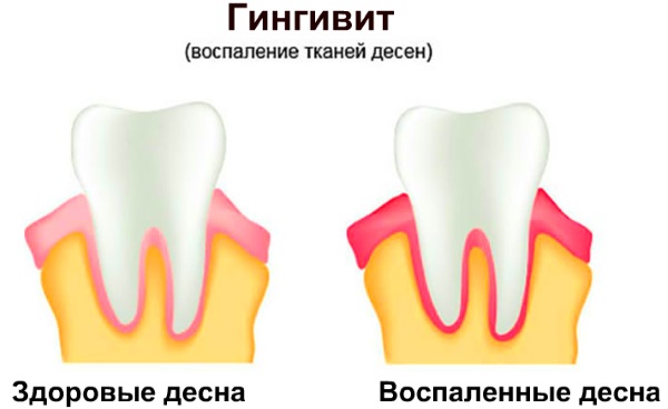 Кислый привкус во рту после еды, с изжогой и без, желтым и белым налетом на языке. Причины и лечение