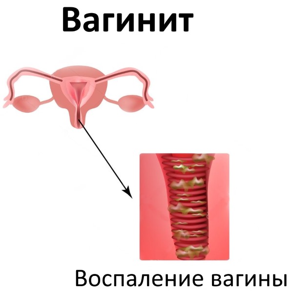 Выделения при беременности на ранних сроках. Нормы, какие бывают, что значат