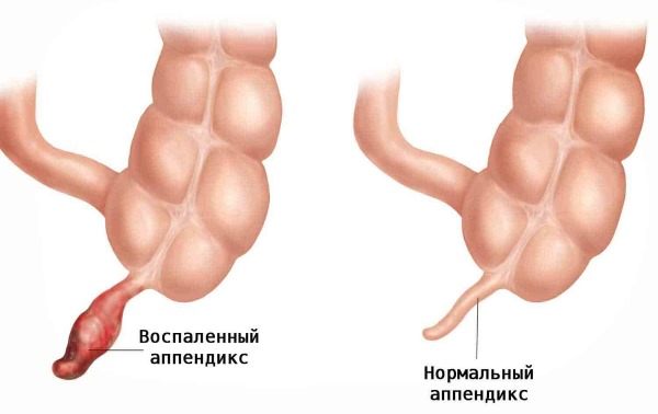 Симптомы аппендицита у ребенка. Первые признаки воспаления, как проявляется острый, температура, анализы крови