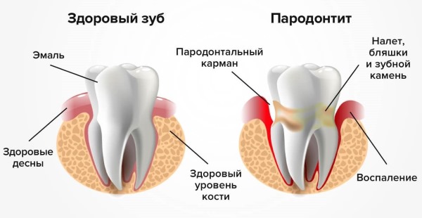 Жжение языка, неба, губ, горла. Причины и лечение у взрослых народными средствами