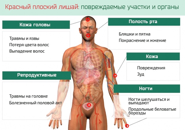 Красный плоский лишай у человека. Фото, стадии, признаки, лечение. Клинические рекомендации