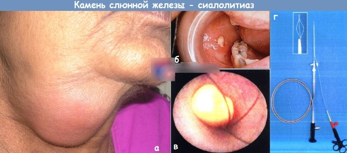 Околоушная слюнная железа человека. Иннервация, анатомия, гистология