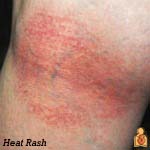 heat rash - image - healthychildren.org