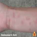 Swimmers Itch - Image - HealthyChildren.org