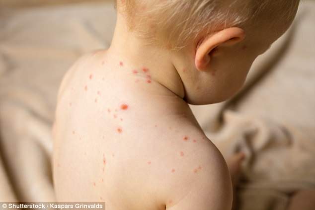 Chickenpox is a common illness that causes a red rash and a fever - and it