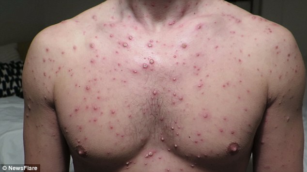 The 32-year-old man uploaded a video showing a horrific case of adult chickenpox in which his entire body is covered in huge, white, fluid-filled blisters