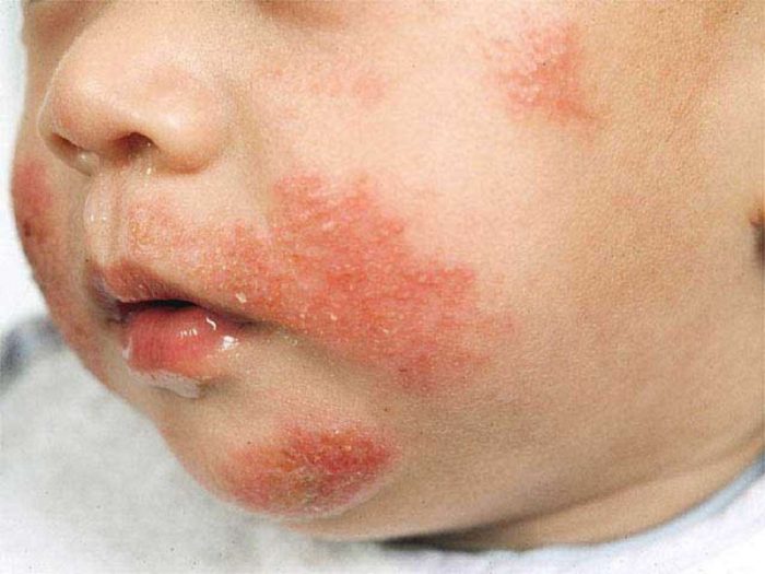 атопический дерматит развивается у малышей до трех лет