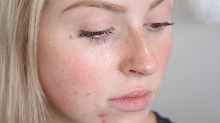 шелушение кожи на лице у женщин