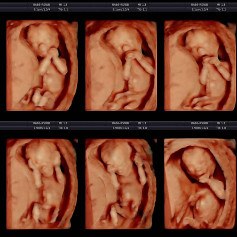 Снимок УЗИ с 3D. Обычная картинка УЗИ плоская, специальные программы позволяют получить объемное изображение. Цвет изображения — условный оттенок телесного, его нельзя увидеть с помощью УЗИ, фактический цвет кожи ребенка может отличаться. Этот метод можно использовать для&nbsp;диагностики генетических заболеваний внутриутробно. Источник: Reveal Ultrasound Studio
