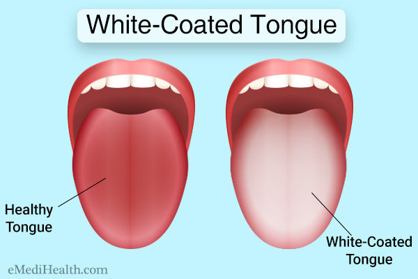 White coated tongue representation