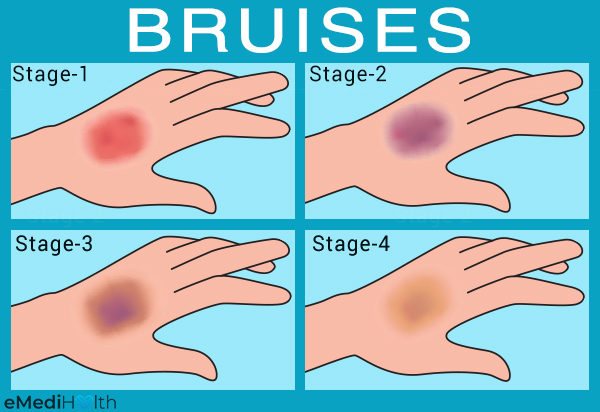 healing bruise