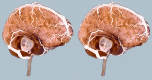 МРТ при опухоли мозга