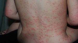 Причины прыщей на теле-аллергия