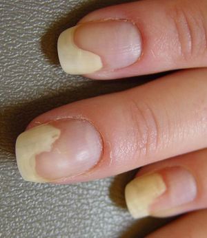 От чего происходит расслоение ногтей