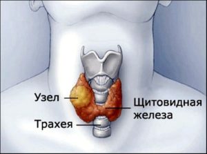 узел в щитовидной железе