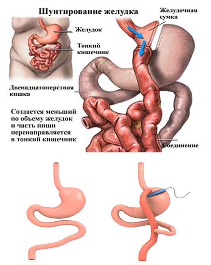 Липосакция живота.