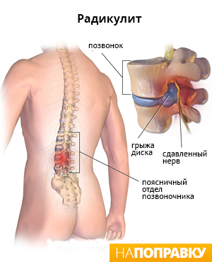 Механизм развития радикулита (схема)