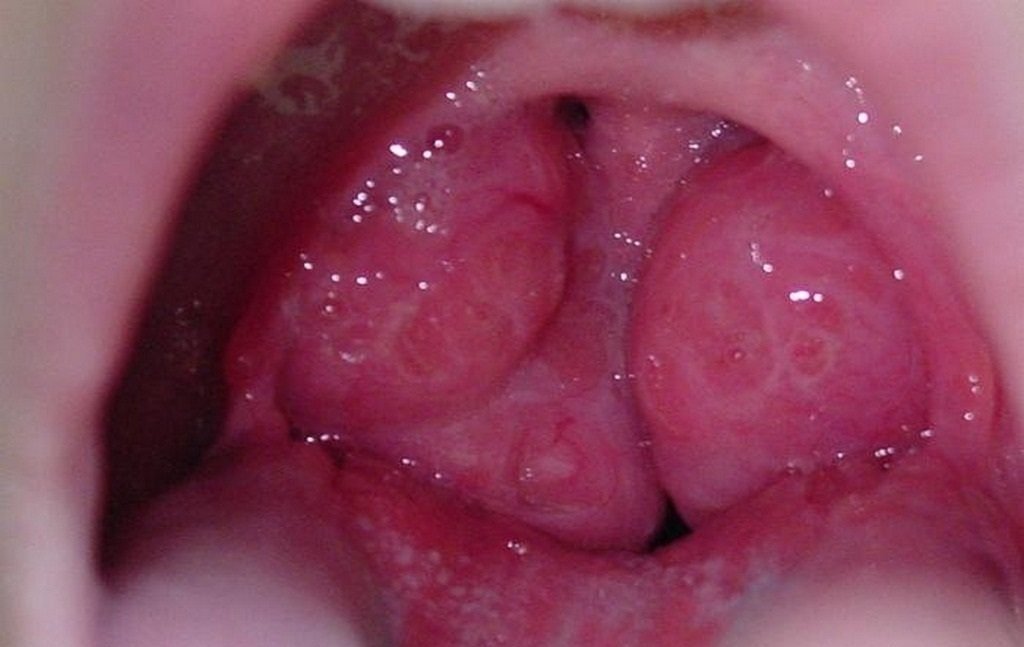Причины увеличения миндалин в горле у ребенка