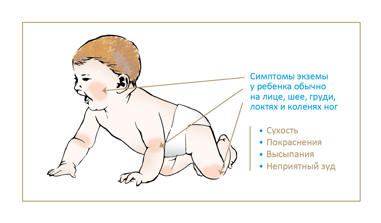 Симптомы экземы у ребенка обычно на лице, шее, груди, локтях и коленях ног