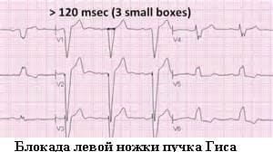 Блокада ножек пучка Гиса