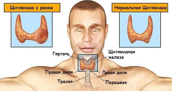 Показания к операции на щитовидной железе