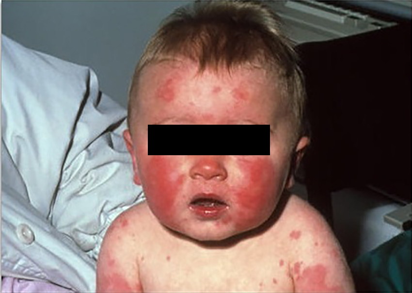Сыпь у детей, пятая болезнь, инфекционная эритема, у детей, фото, след от пощечины