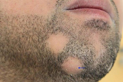 Как проявляется дерматофитоз на бороде