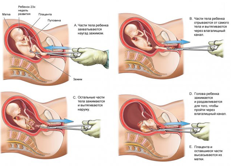 Хирургическое прерывание беременности