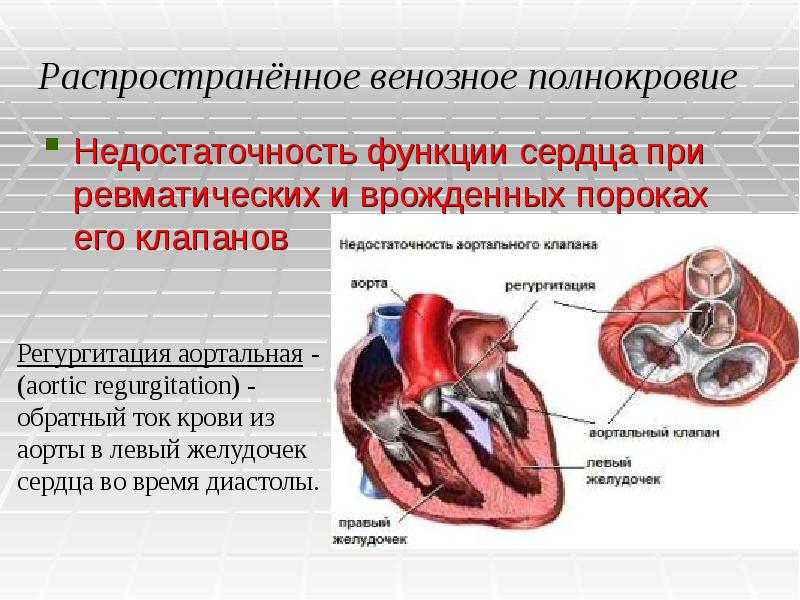 Регургитацией называется. Аортальная регургитация. Регургитация клапанов сердца. Регургитация аортального клапана. Регургитации на клапанах сердца.