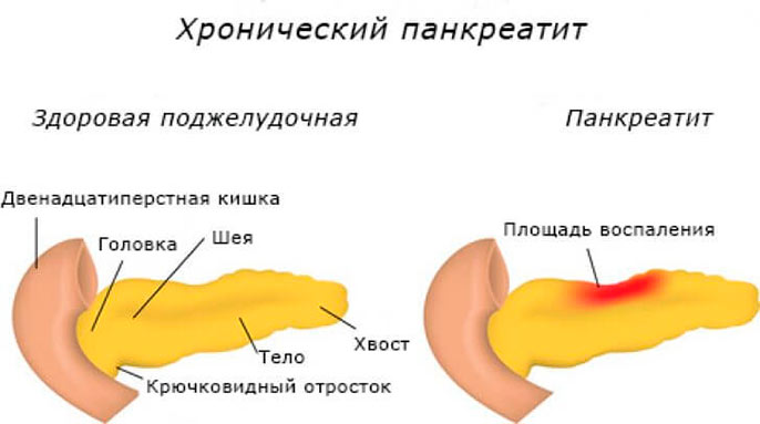 Тяжесть в желудке причины