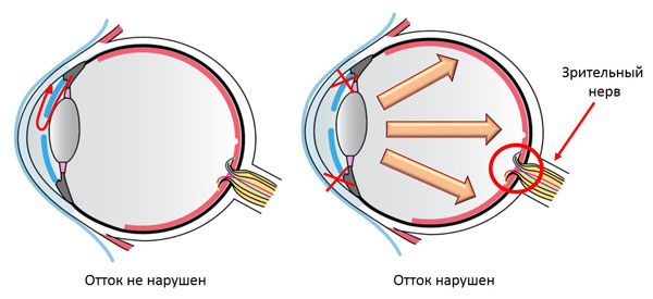 глаукома