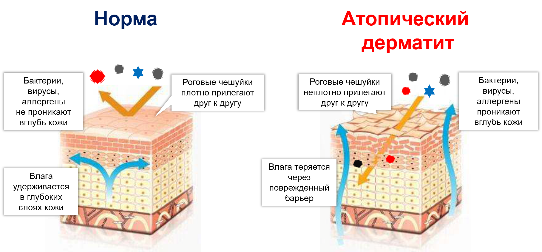 Дерматит степени. Нарушение барьерной функции кожи при атопическом дерматите. Атопический дерматит схема структуры кожи. Строение кожи при атопическом дерматите. Атопический дерматит строение кожи.